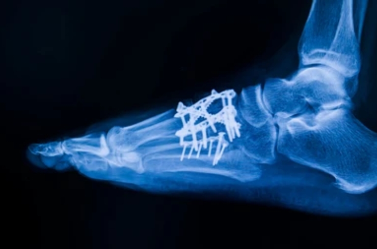 Arthrodesis