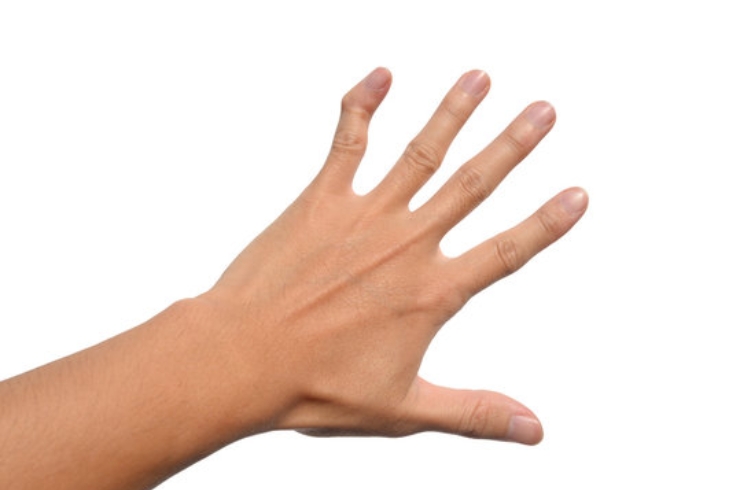 Mallet Finger